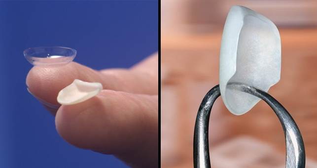 carillas dentales en coslada