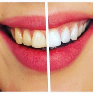 Implantes dentales Coslada -1ª visita GRATIS⭐️ `