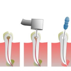 Implantes dentales Coslada -1ª visita GRATIS⭐️ `