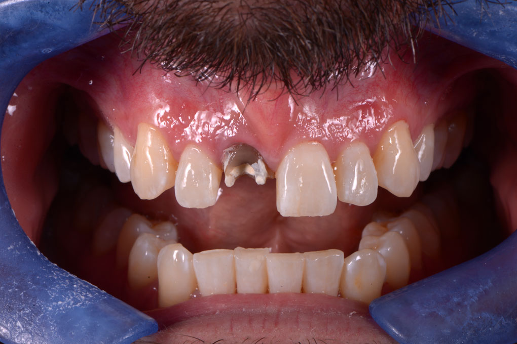 Implantes dentales Coslada -1ª visita GRATIS⭐️ `