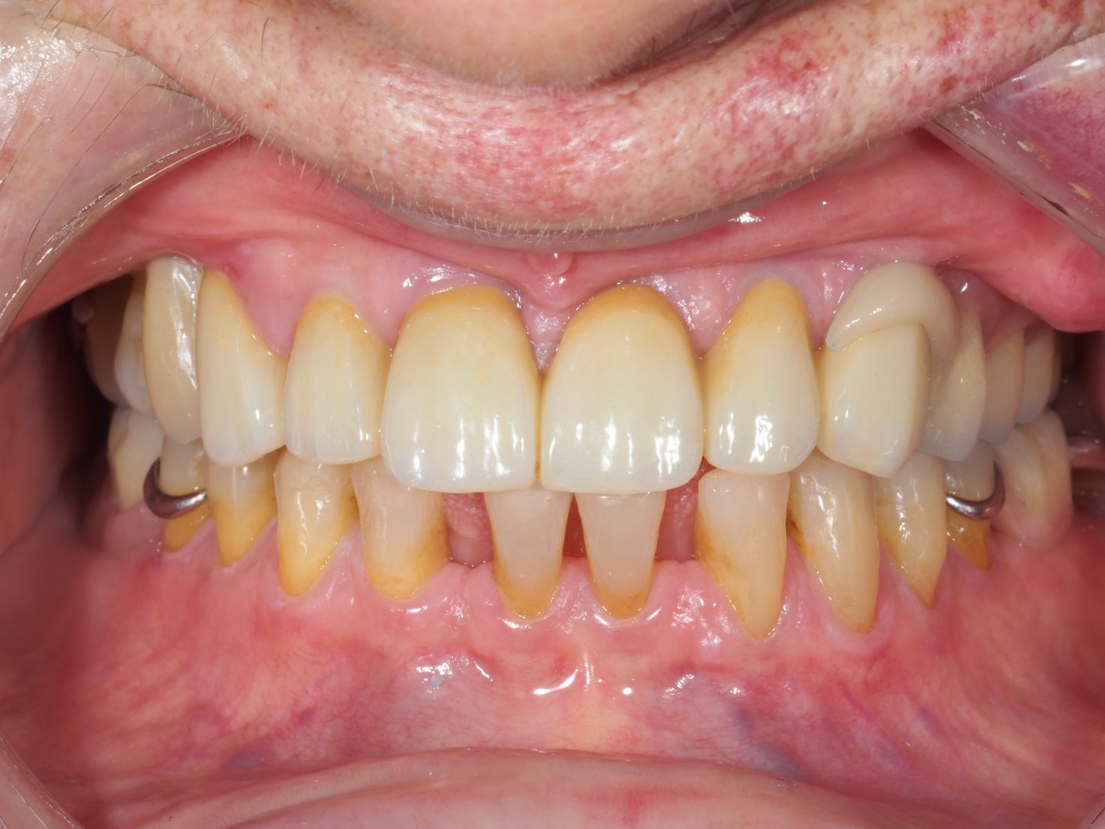 Implantes dentales Coslada -1ª visita GRATIS⭐️ `