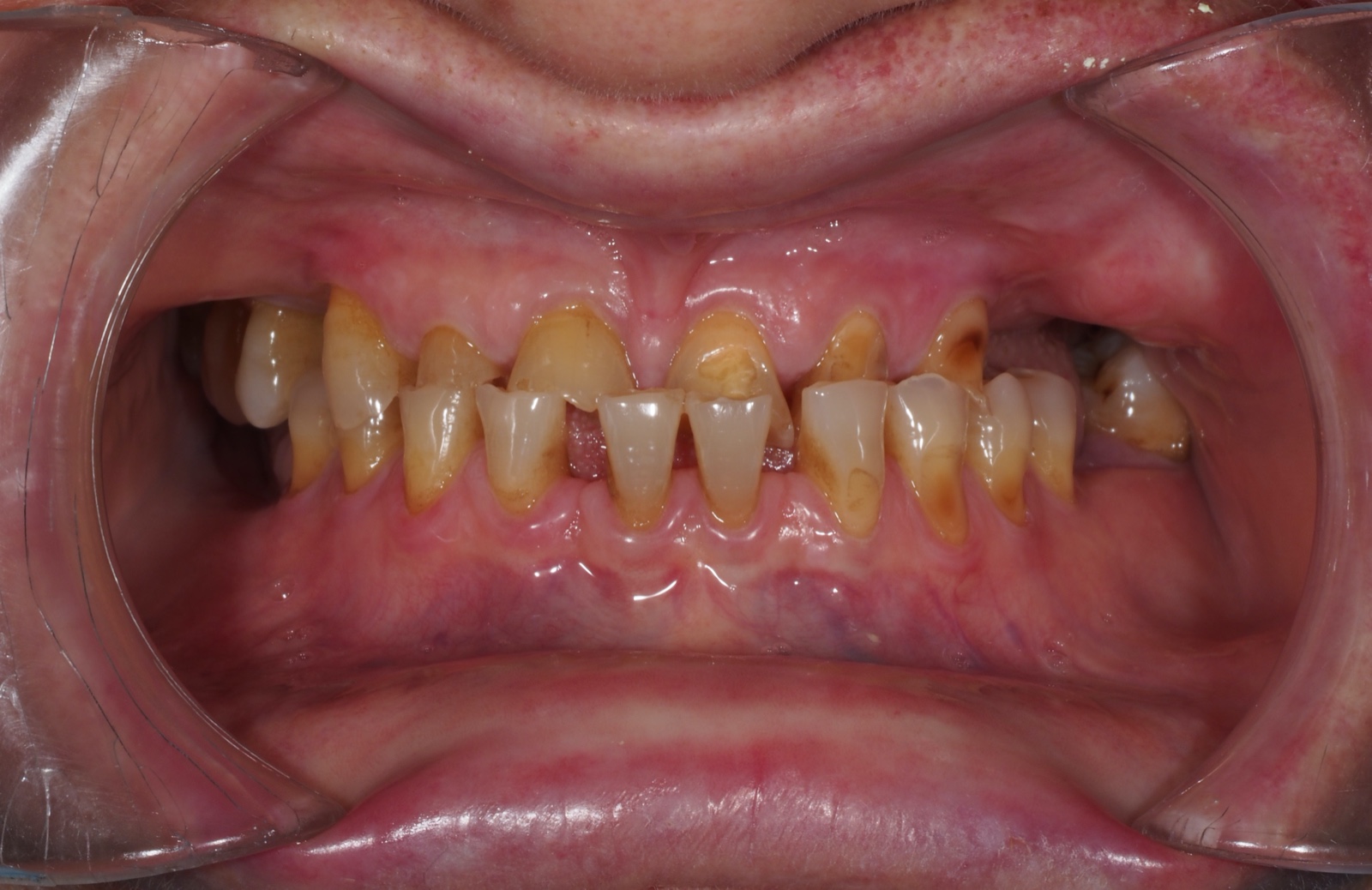 Implantes dentales Coslada -1ª visita GRATIS⭐️ `