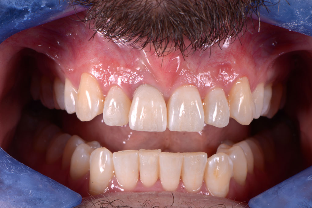 Implantes dentales Coslada -1ª visita GRATIS⭐️ `