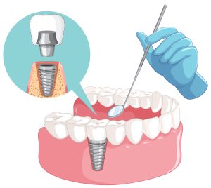 Implantes dentales Coslada -1ª visita GRATIS⭐️ `